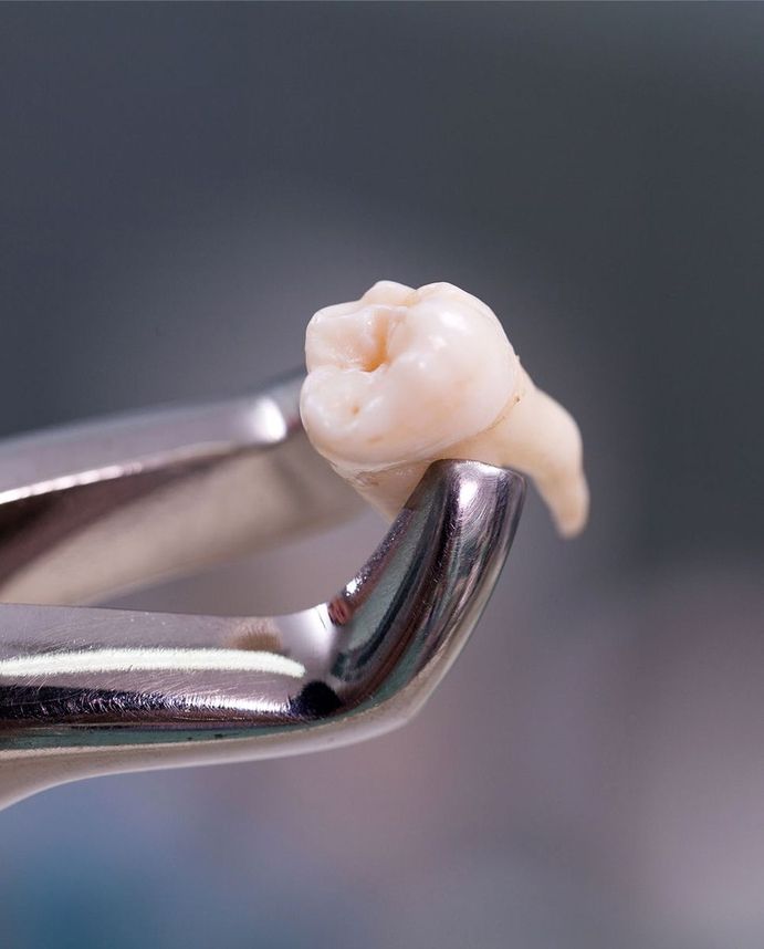 Gezogener Zahn - Nahaufnahme